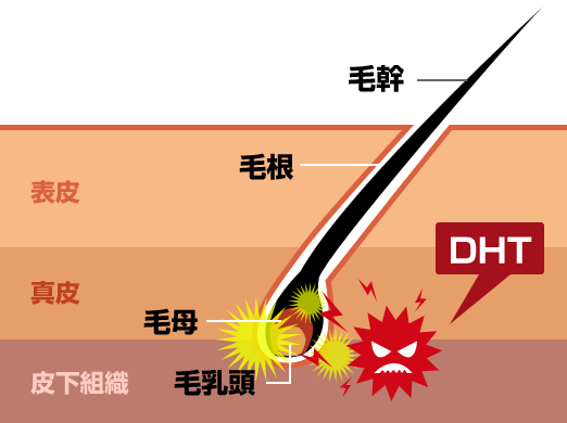AGAの原因