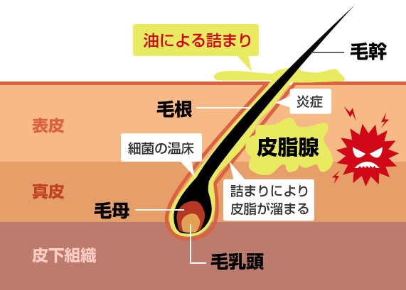 皮脂の異常分泌