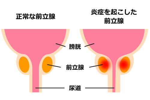 前立腺炎のイメージ