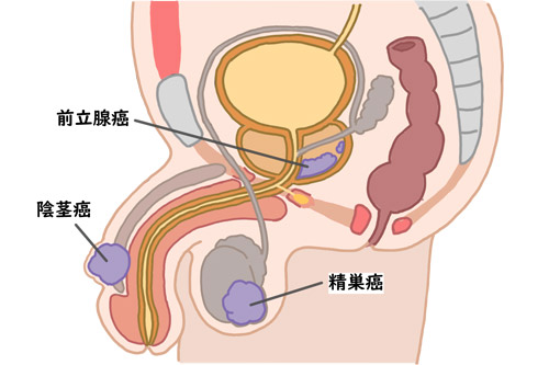 前立腺がんの図